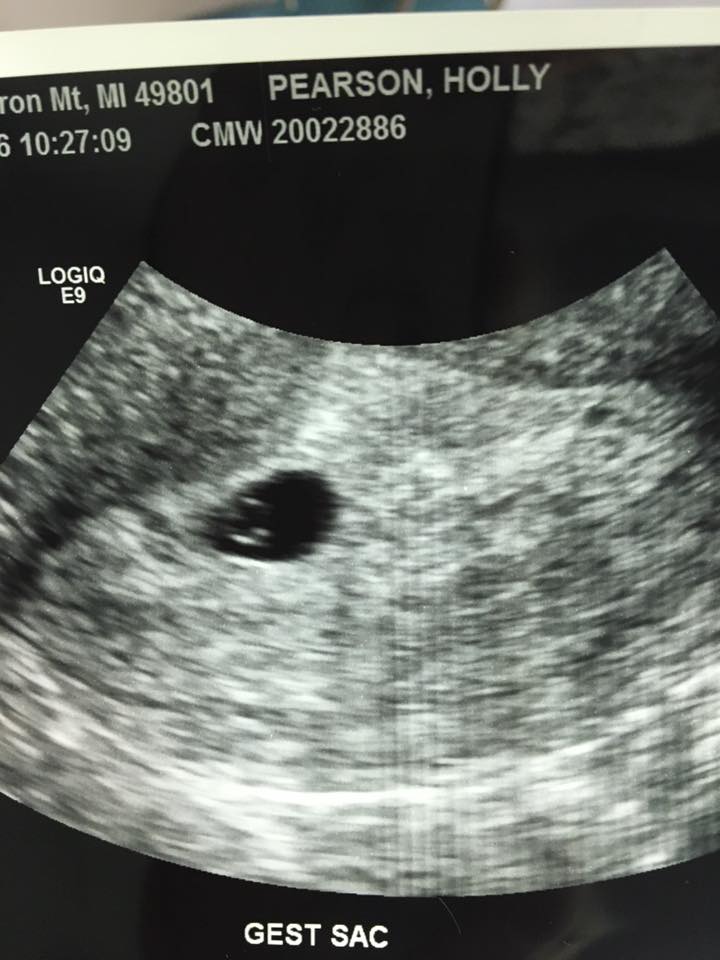 early pregnancy test gestational sac, 5 weeks pregnant